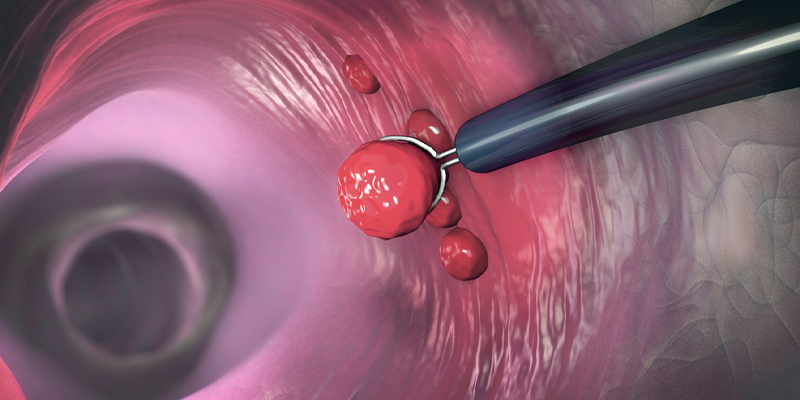 Medical illustration of colon polyp removal during colonoscopy.
