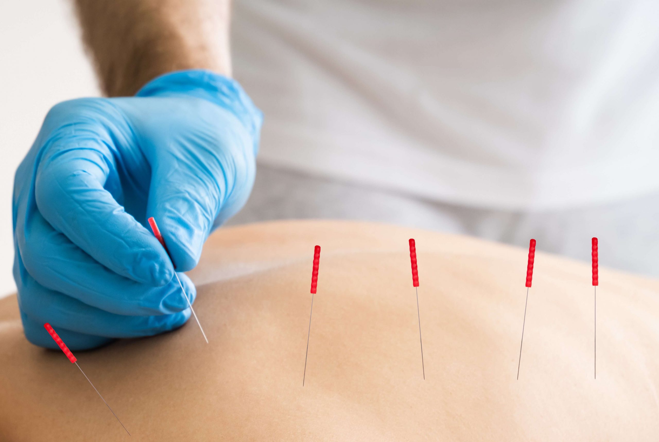 Acupuncture treatment with needles on patient's back.