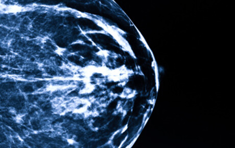 Mammogram image showing breast tissue for medical analysis.