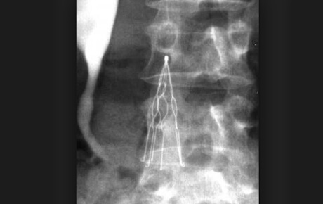 X-ray showing ingested foreign object in stomach.