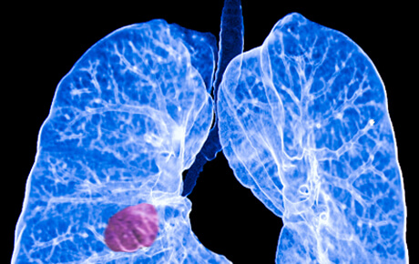 Human lungs with visible tumor, medical imaging.