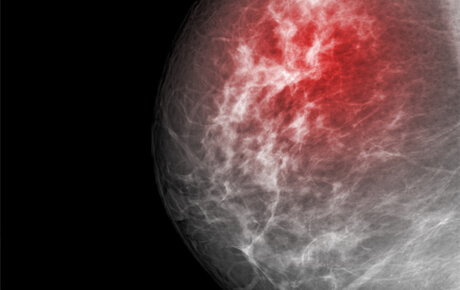 Mammogram showing breast tissue with possible abnormality highlighted.