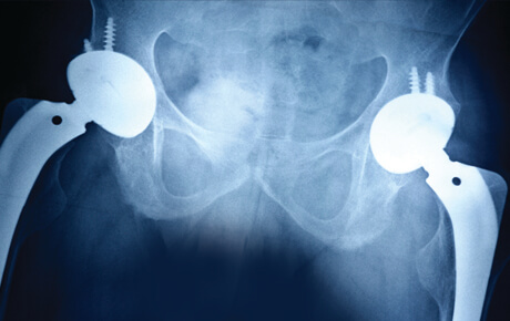 Hip replacement X-ray with bilateral prostheses.