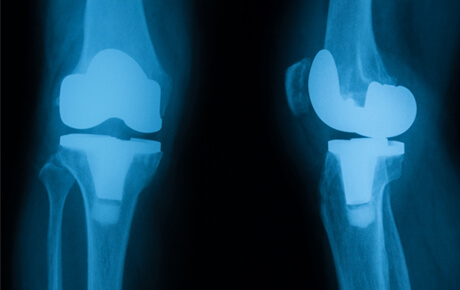 Knee replacement X-ray images.