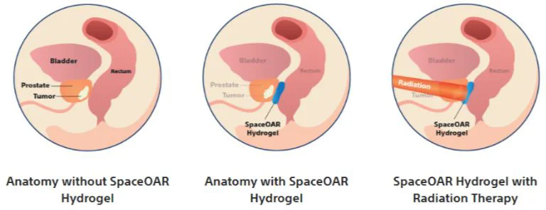 Prostate anatomy and SpaceOAR Hydrogel treatment stages.