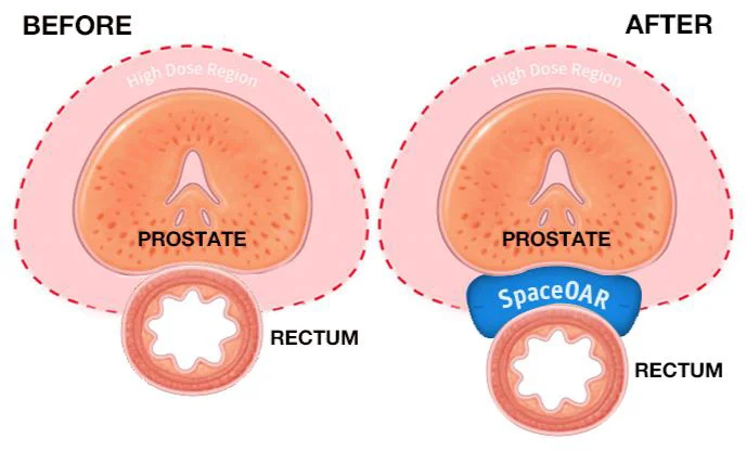 Prostate treatment comparison before and after SpaceOAR.
