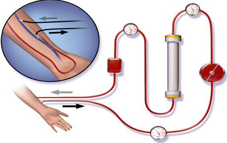 Blood flow in hemodialysis process diagram.