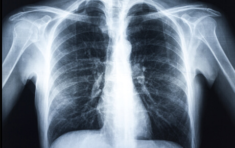 Chest X-ray image showing lungs and bones.